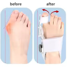 Bunion Fix